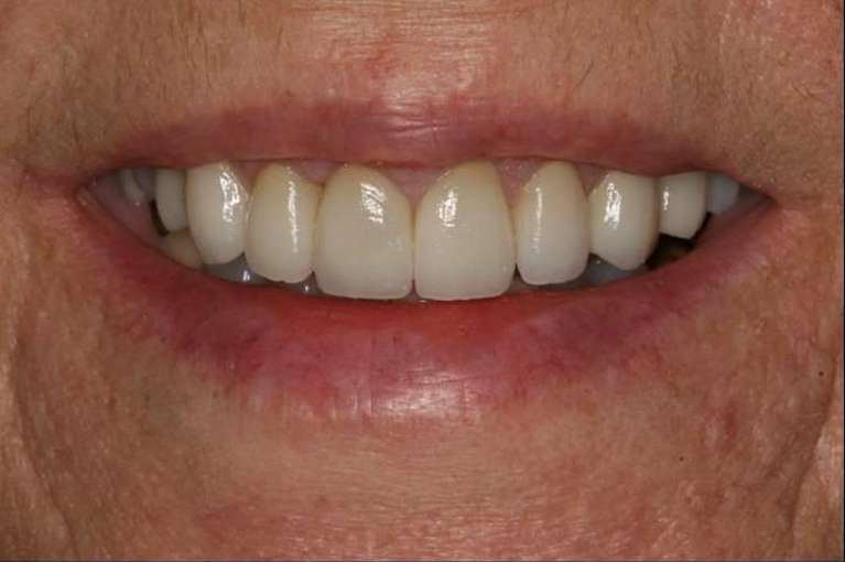 Veneers-After-Image