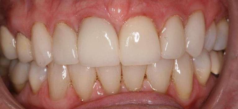 Crown-Veneers-Combination-After-Image