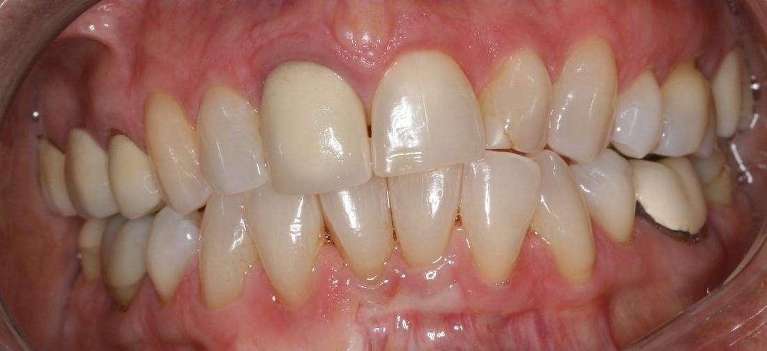 Crown-Veneers-Combination-Before-Image