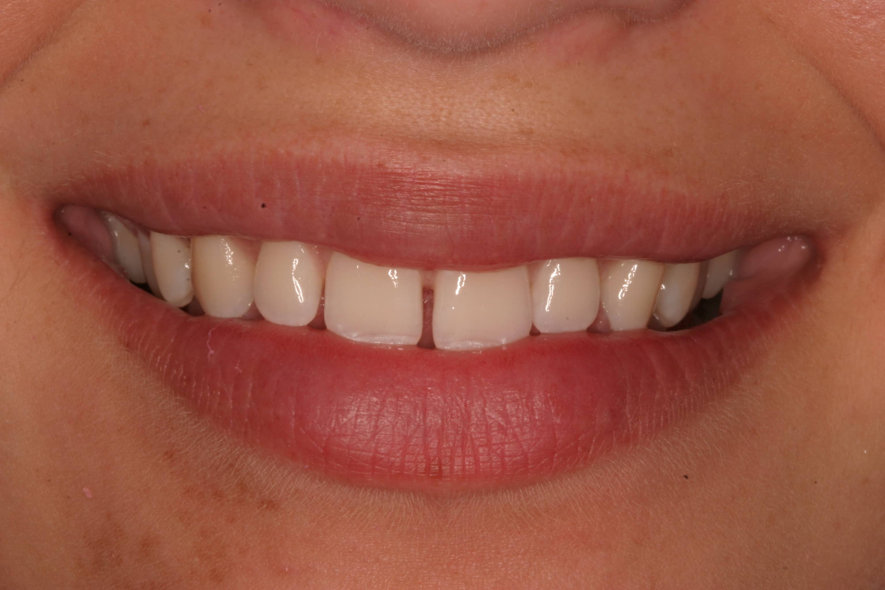 Close-up of a personâs smile before cosmetic dental treatment showing slight gap between front teeth.