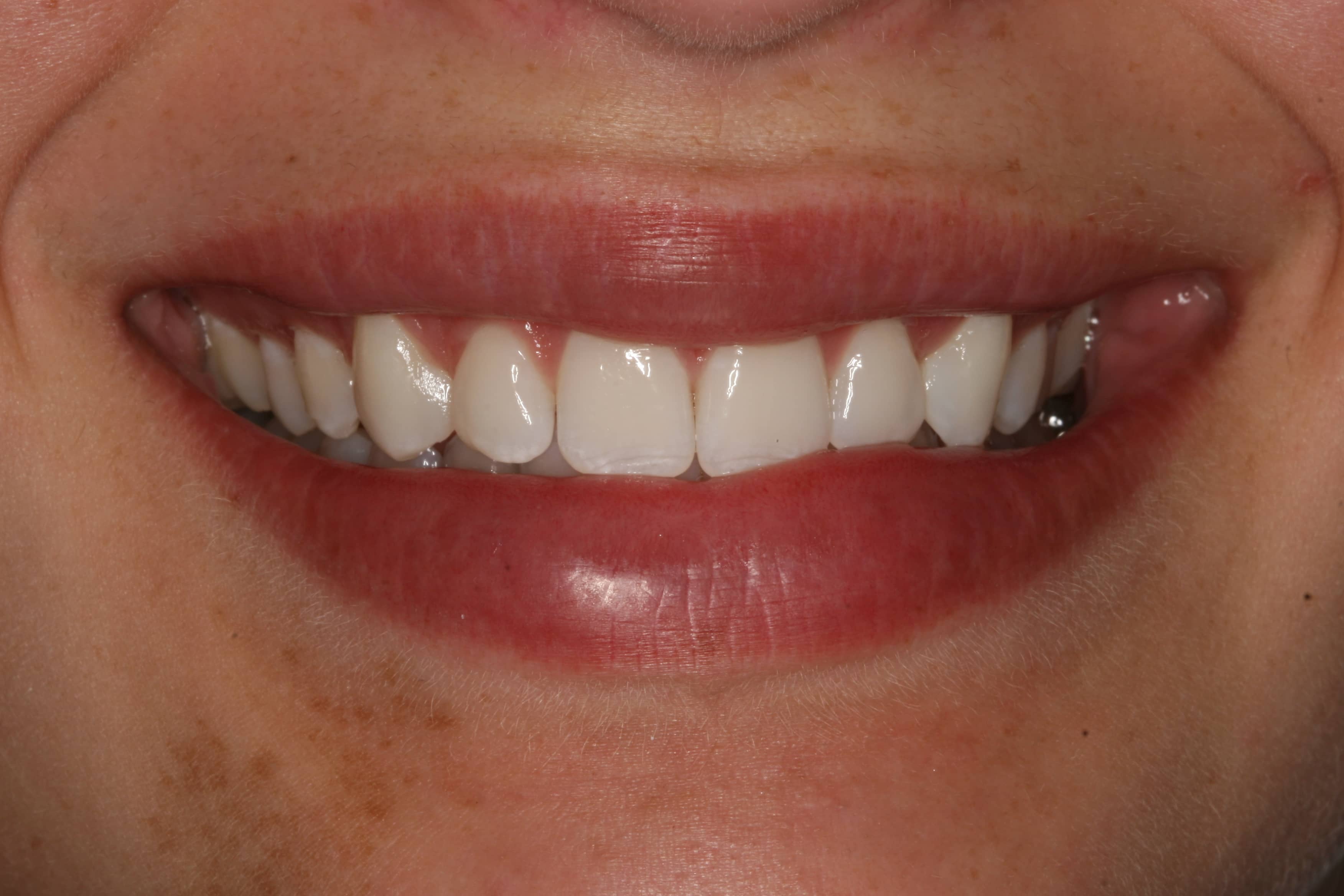 Close-up of the same personâs smile after cosmetic dental treatment with even, bright white teeth and closed gap.